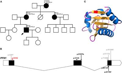 Novel variant c.92T > G (p.Val31Gly) in the PFN1 gene (ALS18) responsible for a specific phenotype in a large Bulgarian amyotrophic lateral sclerosis pedigree